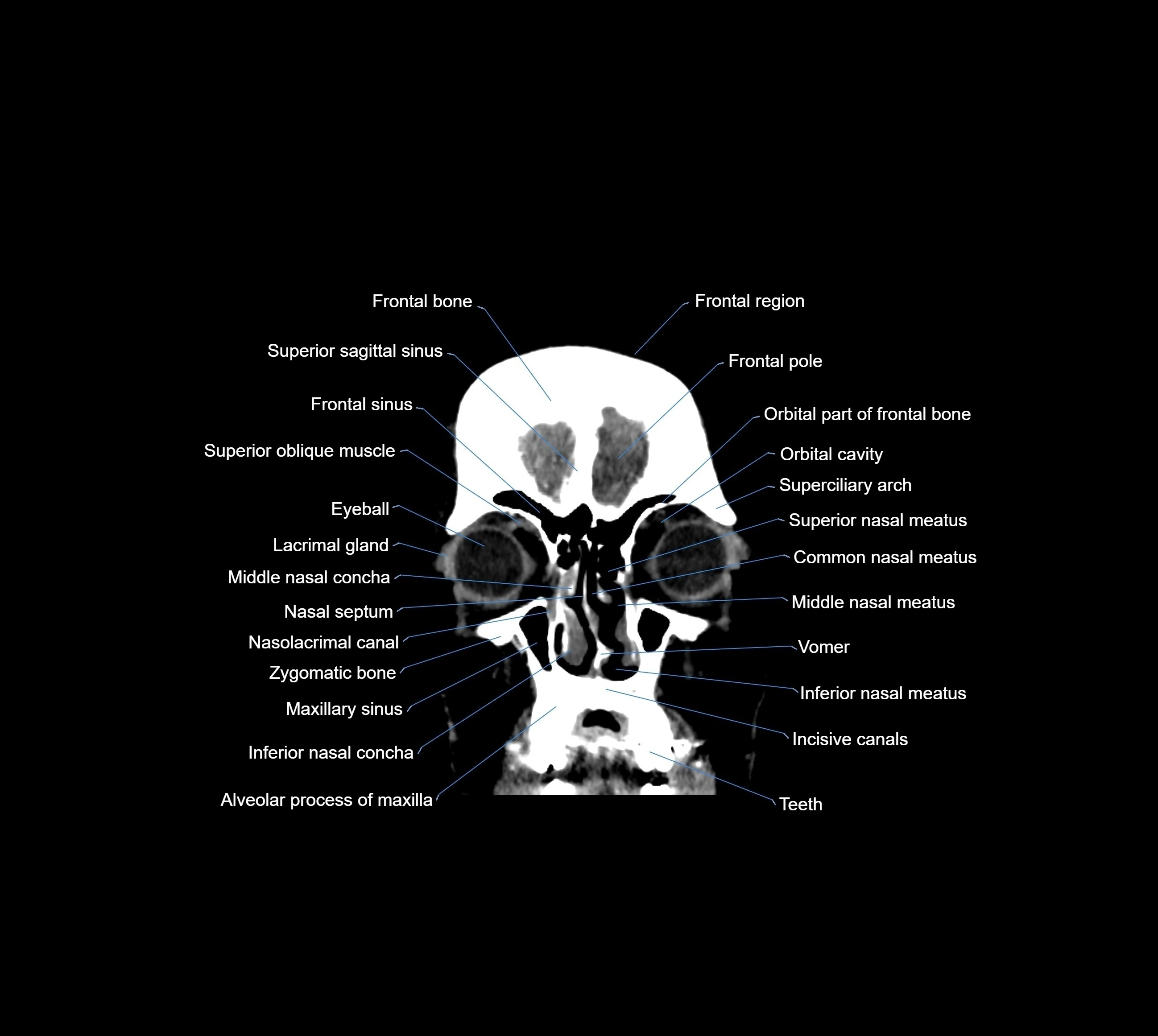 CT Brain coronal cross sectional radiology anatomy image  -img-00001-07.webp